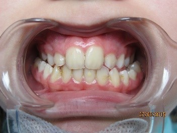 orthodontie enfant 1