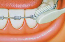brossage appareil d'orthodontie