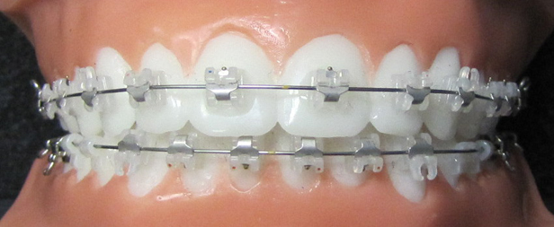 orthodontie adulte 1