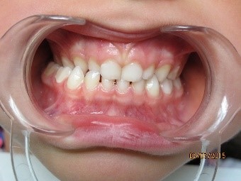orthodontie enfant 2