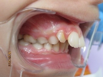 orthodontie enfant 3