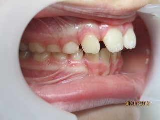 orthodontie enfant 5