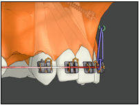 minivis orthodontique