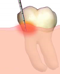 sondage parodontal